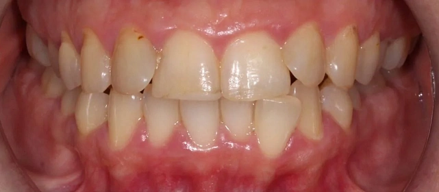 Лечение скученности и неправильного прикуса на элайнерах 3D Smile