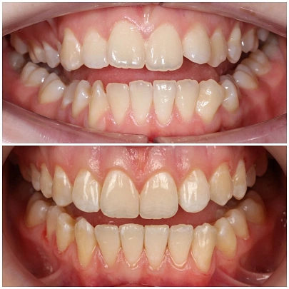 Неровные зубы и нарушение прикуса — лечение на элайнерах 3D Smile