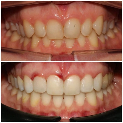 Глубокий прикус и сужение челюстей — лечение на брекетах Damon