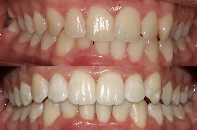 Скученность зубов и сужение челюстей — лечение на элайнерах Click