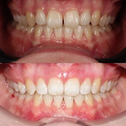 Скученность зубов и сужение челюстей — лечение на брекетах за 15 месяцев