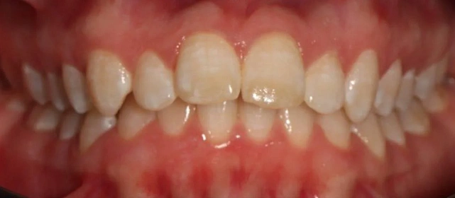 Лечение неправильного положения зубов на брекет-системе за 14 месяцев