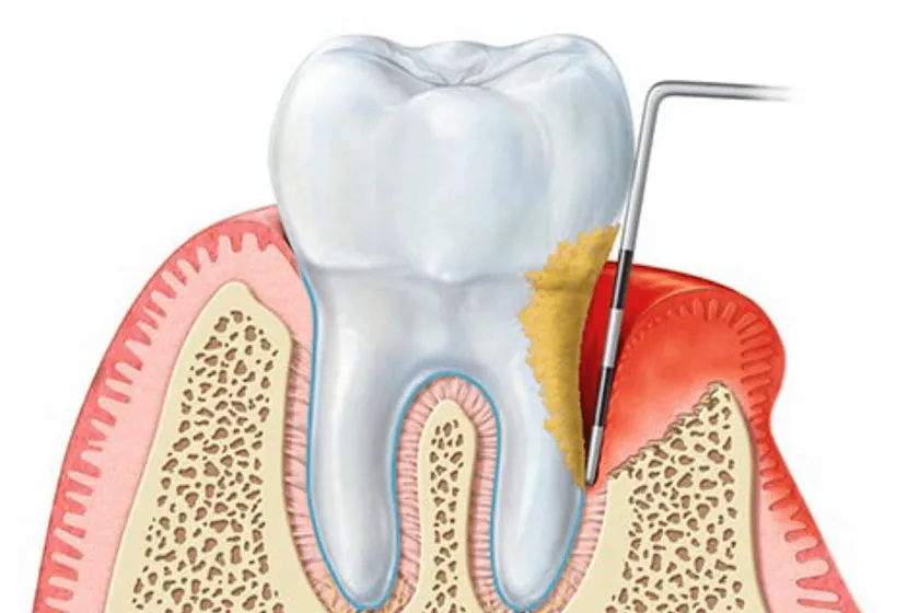 Пародонтит