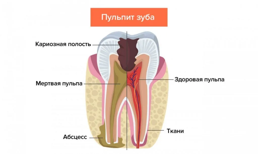 Фото лечения пульпита