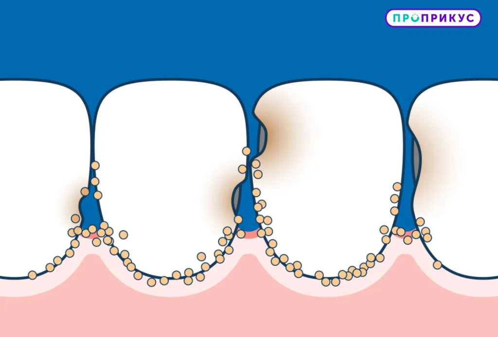 межзубный кариес фото