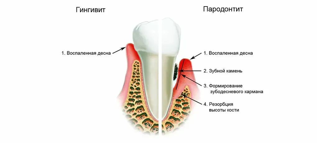 Лечение десен в домашних условиях