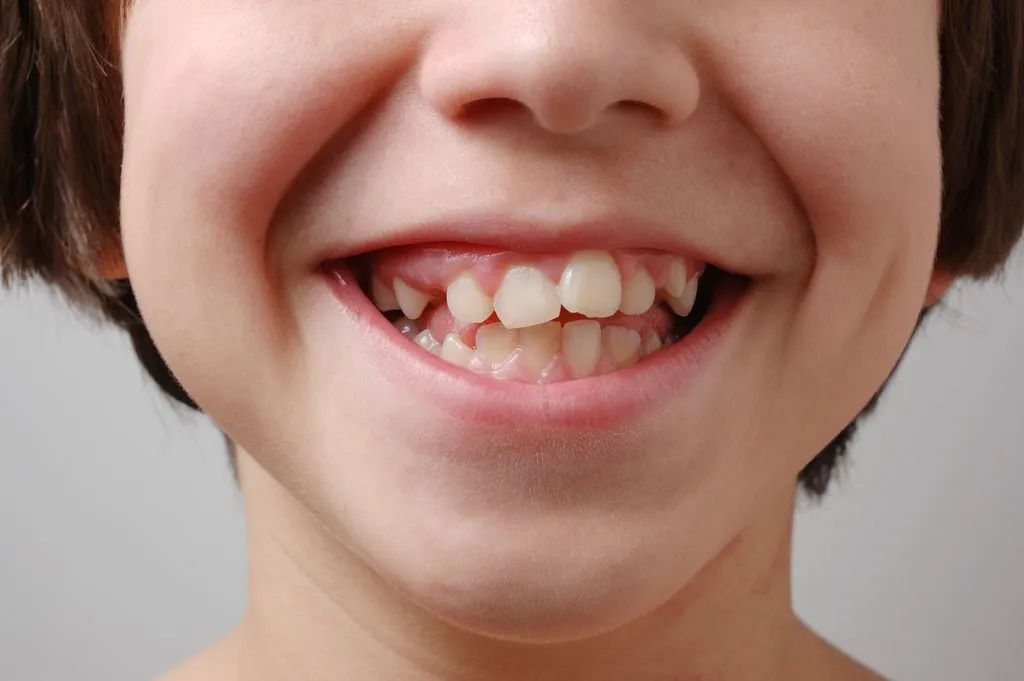 Кривые зубы у ребенка