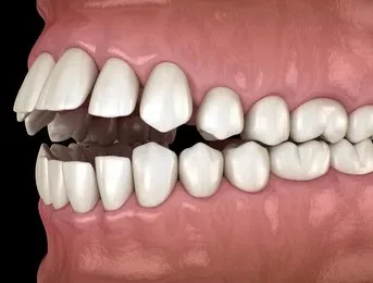 окклюзия зубов