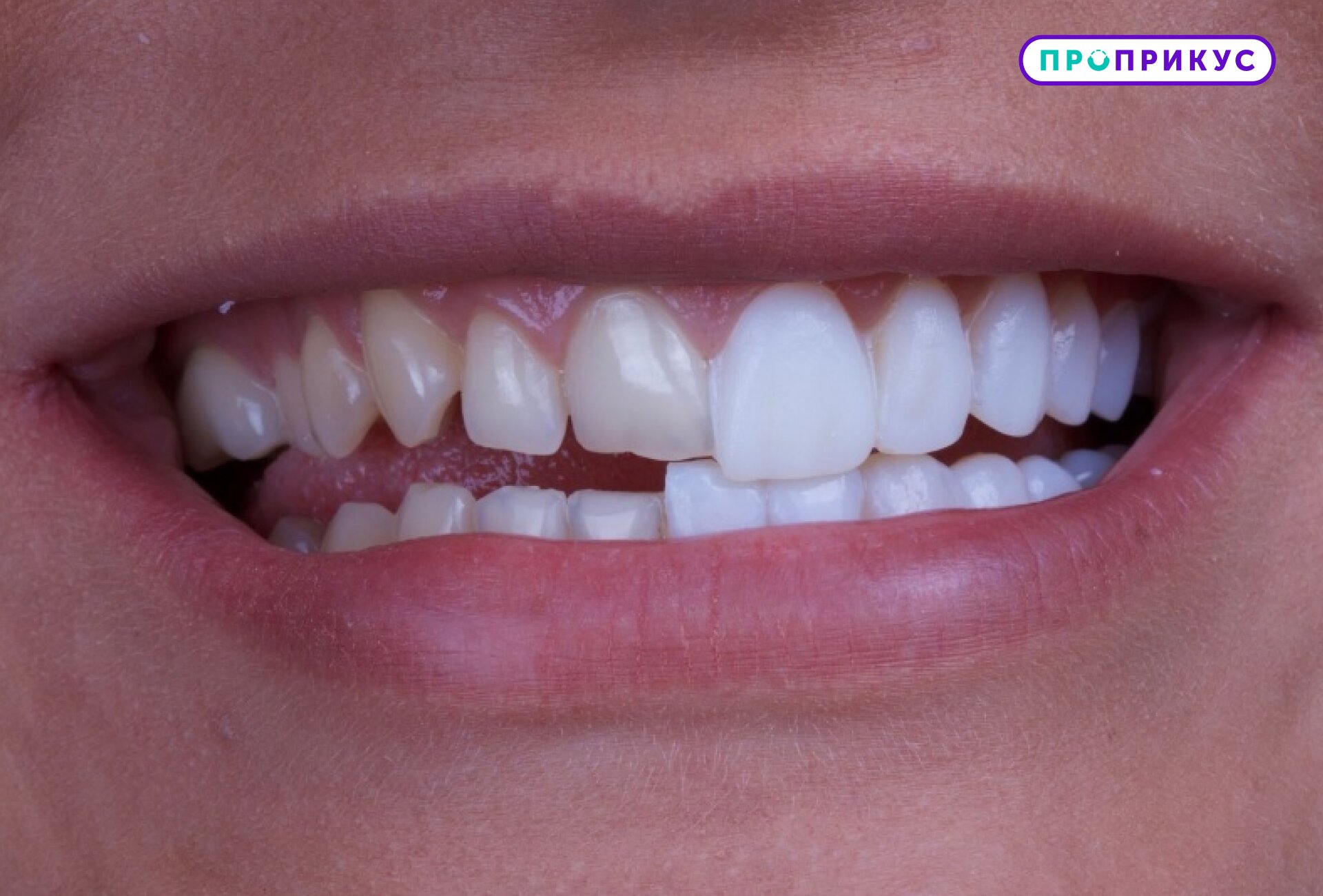 Сколько больных зубов можно вылечить за один прием?