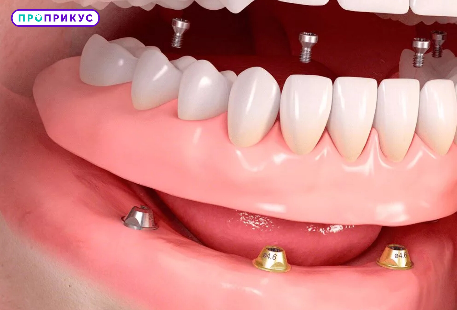 Протезирование при отсутствии трех жевательных зубов с одной стороны