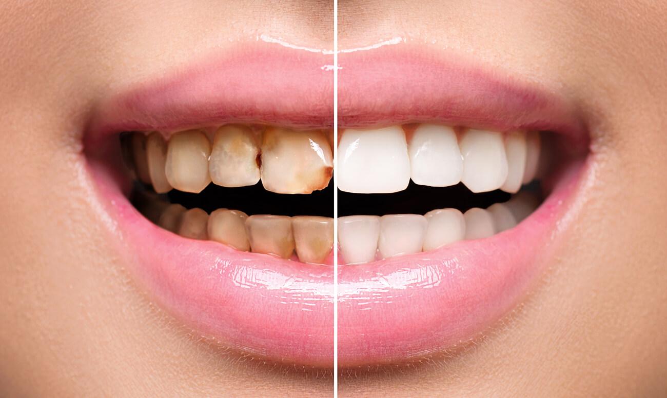 В каких случаях проводится реставрация зубов?