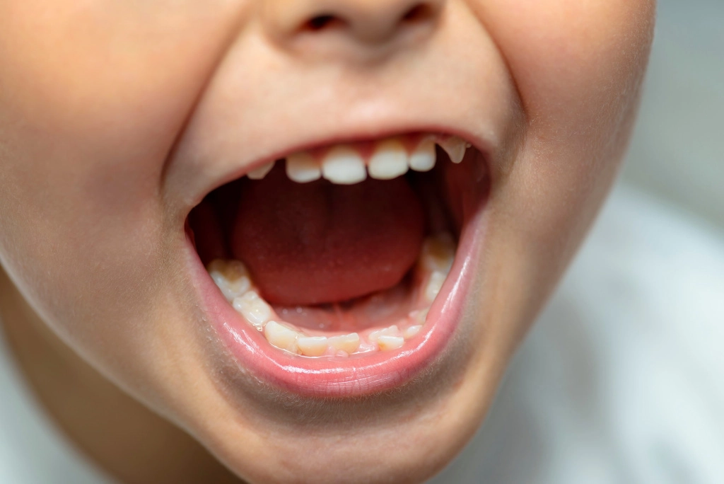 Почему зубы растут неровно и что делать - Статья стоматологии Доктор Келлер в Ростове-на-Дону