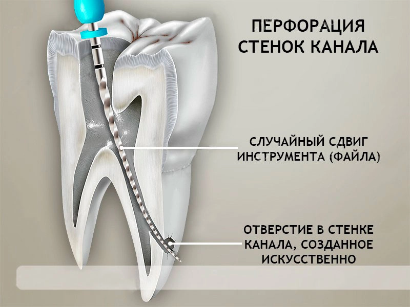 Пасты для лечения каналов зуба